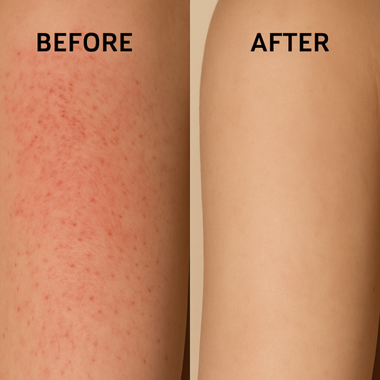 Say Goodbye to Keratosis Pilaris ("Chicken Skin") with These Exfoliation Tips